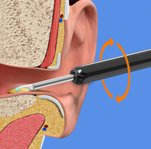 Cargue la imagen en el visor de la galería, StopCerumen - Nettoyeur d'Oreilles